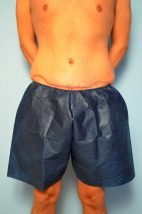 Male Tummy Tuck