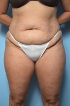 Abdominoplasty, Liposuction
