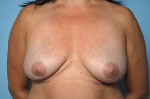 Removal of Breast Implants
