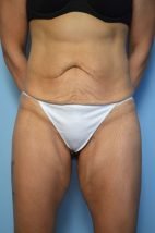 Abdominoplasty