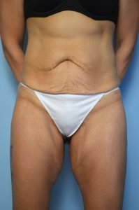 Abdominoplasty