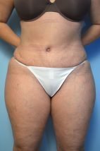 Abdominoplasty, Liposuction