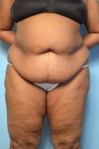 Abdominoplasty, Liposuction