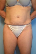 Abdominoplasty