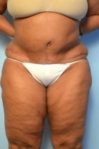 Abdominoplasty, Liposuction