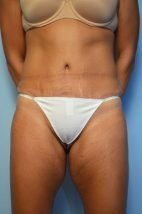 Abdominoplasty