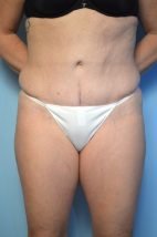 Abdominoplasty