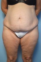 Tummy Tuck with Lipo