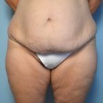 tummy tuck before