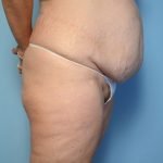 tummy tuck before