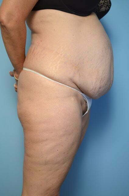 tummy tuck before