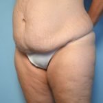 tummy tuck before