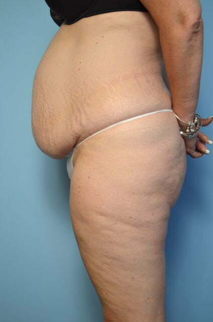 tummy tuck before