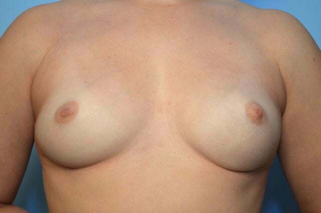 removal of breast implants