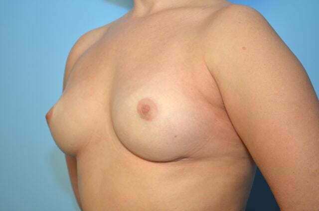 removal of breast implants