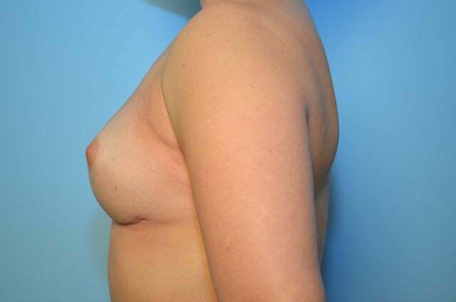 removal of breast implants