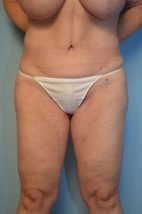 Tummy Tuck