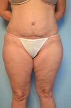 Tummy Tuck with Lipo