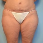 tummy tuck after