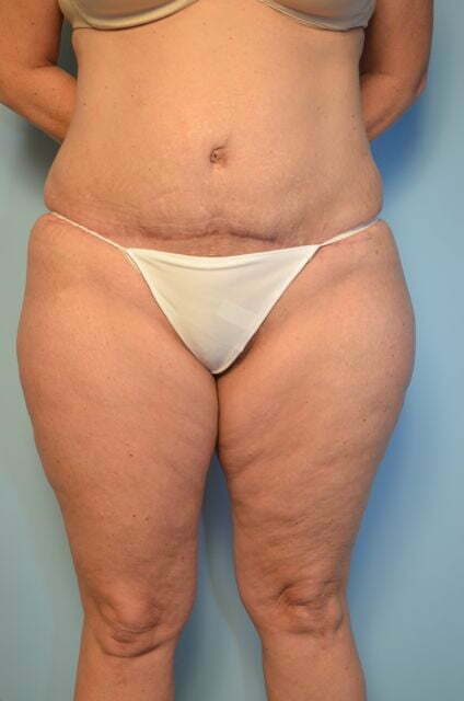 tummy tuck after