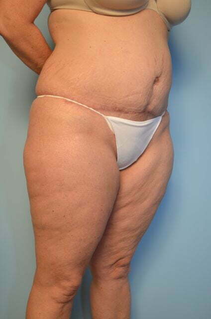 tummy tuck after