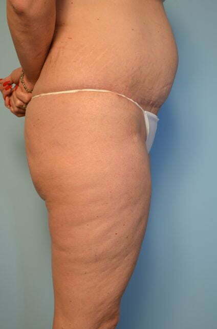 tummy tuck after