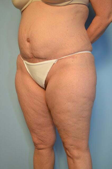 tummy tuck after