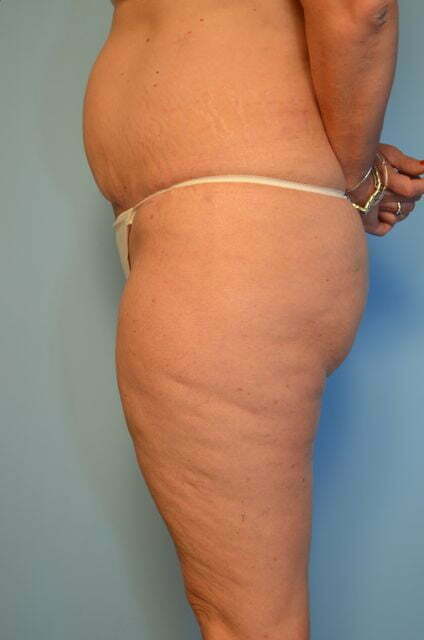 tummy tuck after