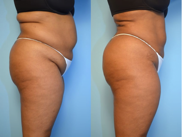 before and after liposuction to hips, lower back, abdomen. Removing fat enhanced the patient's buttock shape.