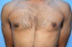 Gynecomastia Reduction