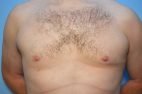 Gynecomastia Reduction