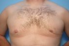 Gynecomastia Reduction