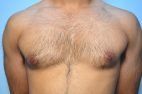 Gynecomastia Reduction