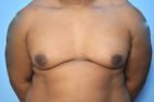 Gynecomastia Reduction