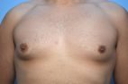 Gynecomastia reduction