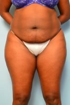 Abdominoplasty/Liposuction