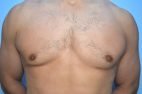 Gynecomastia Reduction