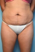 Abdominoplasty/Liposuction