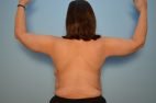 Brachyplasty (arm lift)