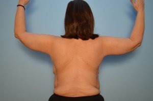 Brachyplasty (arm lift)