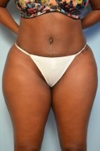 Abdominoplasty/Liposuction
