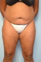 Abdominoplasty/Liposuction