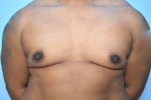 Gynecomastia Reduction