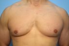 Gynecomastia Reduction