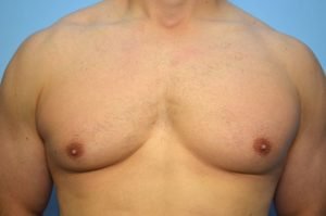 Gynecomastia Reduction