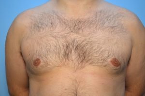 Gynecomastia Reduction