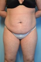 TT + lipo