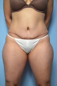 Abdominoplasty/Liposuction