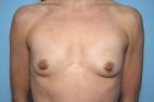 Breast Augmentation