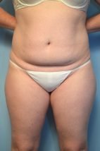 Abdominoplasty/Liposuction